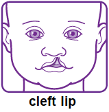 cleft lip
